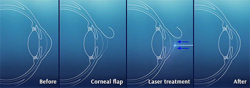 Lasik